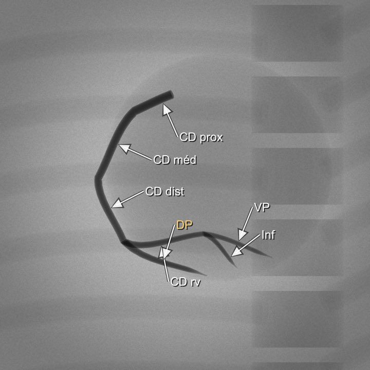 Imagem angiográfica simulada da coronária direita na projeção OAE (lateral esq.) (OAE 30°), com os segmentos rotulados