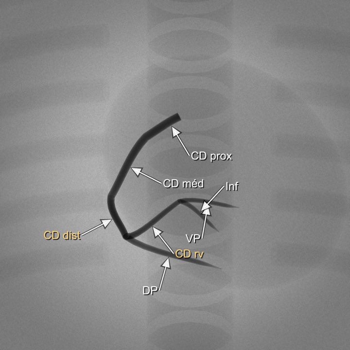 Imagem angiográfica simulada da coronária direita na projeção PA cranial (CRA 30°), com os segmentos rotulados