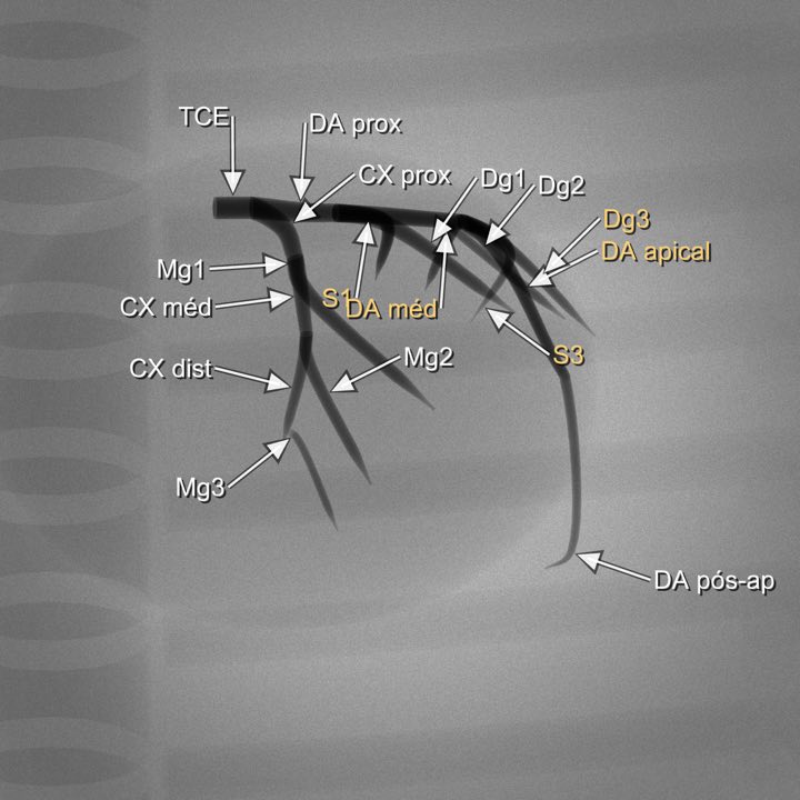 Imagem angiográfica simulada da coronária esquerda na projeção Caudal direita (OAD 20° / CAU 20°), com os segmentos rotulados