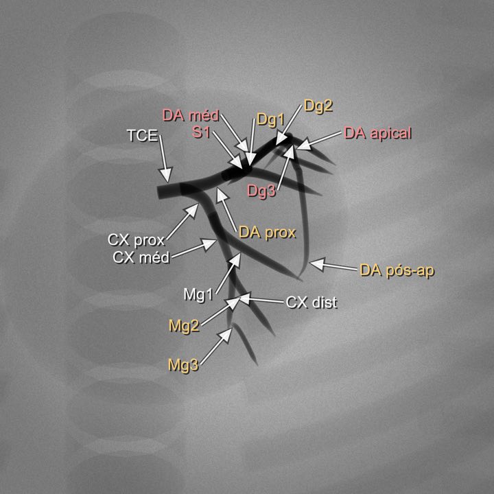 Imagem angiográfica simulada da coronária esquerda na projeção Caudal pura (CAU 40°), com os segmentos rotulados