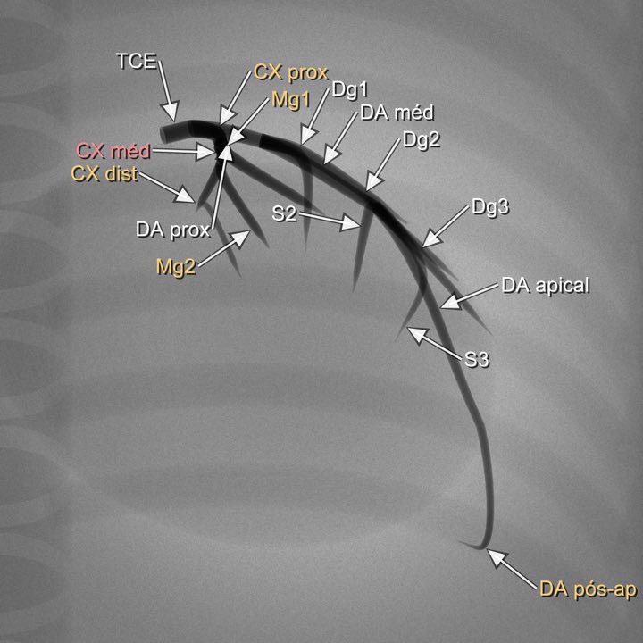 Imagem angiográfica simulada da coronária esquerda na projeção Cranial direita (OAD 30° / CRA 30°), com os segmentos rotulados