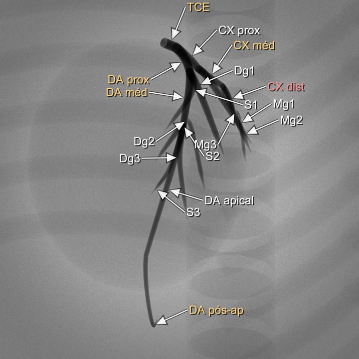 Imagem angiográfica simulada da coronária esquerda na projeção Cranial esquerda (OAE 35° / CRA 25–30°), com os segmentos rotulados