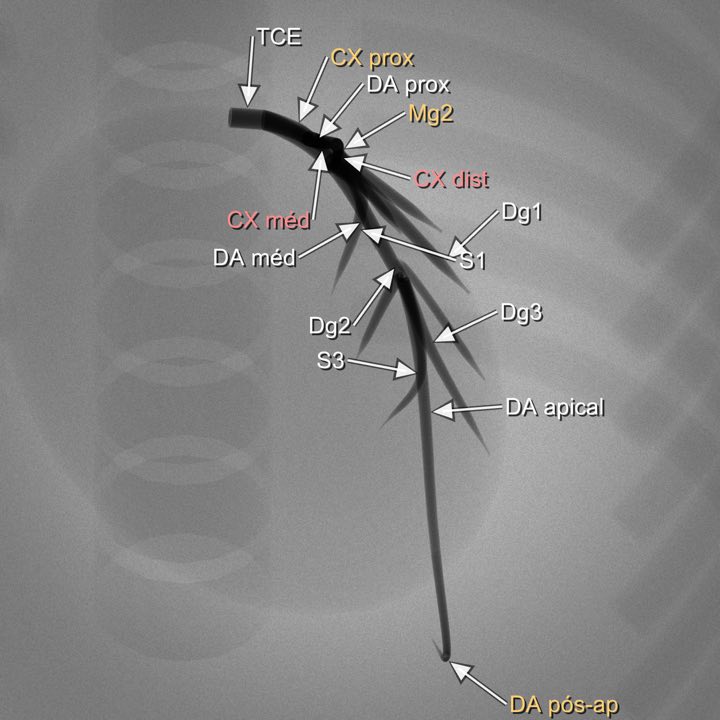 Imagem angiográfica simulada da coronária esquerda na projeção PA cranial (CRA 45°), com os segmentos rotulados