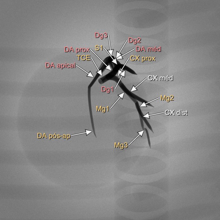 Imagem angiográfica simulada da coronária esquerda na projeção Caudal esquerda (spider) (OAE ≥35° / CAU ≥30°), com os segmentos rotulados