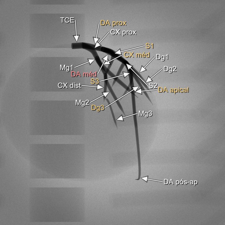 Imagem angiográfica simulada da coronária esquerda na projeção PA (0°/0°) (0° / 0°), com os segmentos rotulados