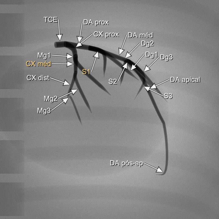 Imagem angiográfica simulada da coronária esquerda na projeção Ventriculografia (OAD 30°), com os segmentos rotulados